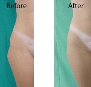 Before and after SmartLipo hip treatment results