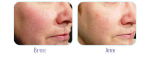 Laser Facial Treatment Before and After