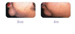 Raleigh Laser Hair Removal at Body Lase