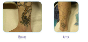Laser Tattoo Removal Procedure at BodyLase