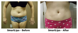 SmartLipo Liposuction Treatment at BodyLase