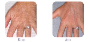 Fraxel Treatment for Hands