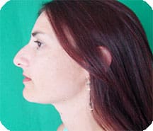 smartlipo_chin_neck_reduction2 SmartLipo Chin-Neck Reduction After