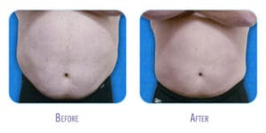 Before and After Zerona Laser Stomach Treatment