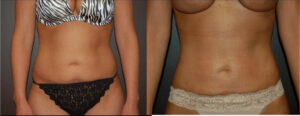 SmartLipo Before and After Stomach treatment