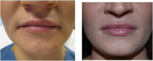 Juviderm Before and After - BodyLase Client