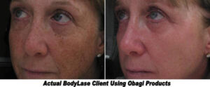 Obagi skin care treatment results | bodylase®