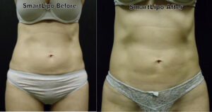 SmartLipo Before and After - Laser Liposuction