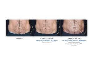 CoolSculpting Elite before and after