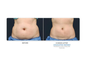 Coolsculpting before and after | bodylase®