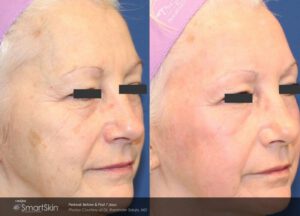smartskin before and after