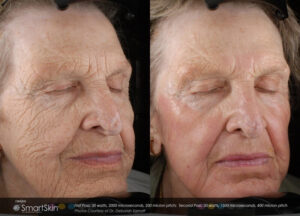 smartskin before and after