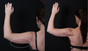 smartlipo before and after arms