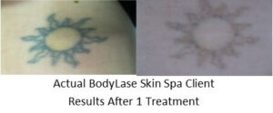 Before and After Laser Tattoo Removal after one treatment