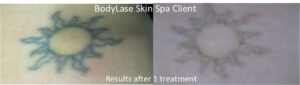 laser tattoo removal results after one treatment