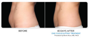 coolsculpting treatment before and after