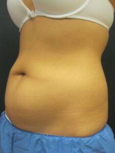 BodyLase coolscultping abdomen treatment