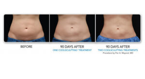 Coolsculpting before and after | bodylase®