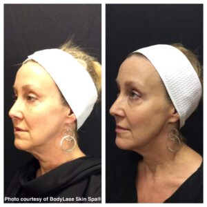 Before and after ultherapy® results | bodylase®