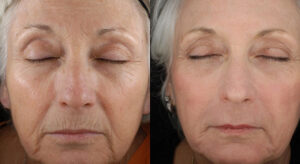 laser skin therapy before and after