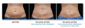 Before and after coolsculpting® elite results | bodylase®