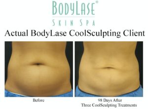 CoolSculpting Elite treatment before and after results
