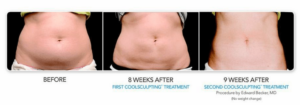 Before and after CoolSculpting® Elite abdomen results