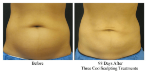 coolsculpting treatment before and after results