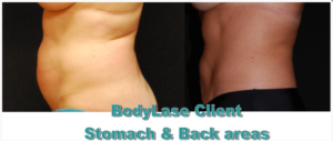Stomach and back before and after | bodylase®