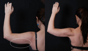 arm treatment before and after results