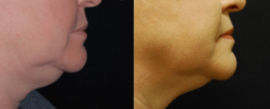before and after chin treatment results