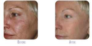 Before and after ultherapy® results | bodylase®