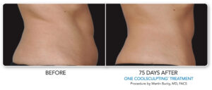 Before and after CoolSculpting® Elite results