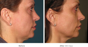 ultherapy neck before and after