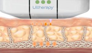 BodyLase ultherapy treatment