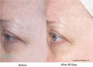 Ultherapy eyes treatment before and after | bodylase®