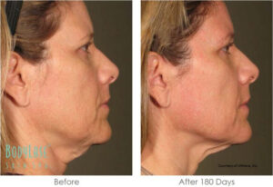 Ultherapy neck before and after results | bodylase®