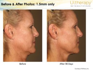 ultherapy neck before and after