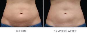 coolsculpting before and after results