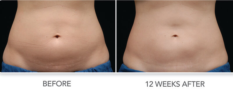coolsculpting before and after results