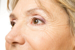 Eye wrinkle treatment | bodylase®