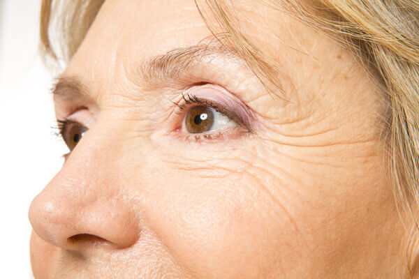 eye wrinkle treatment