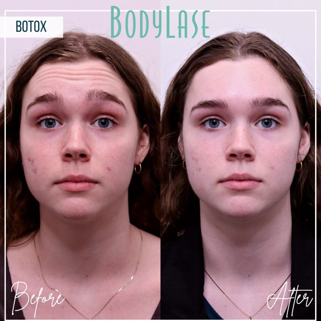 Botox Before and After