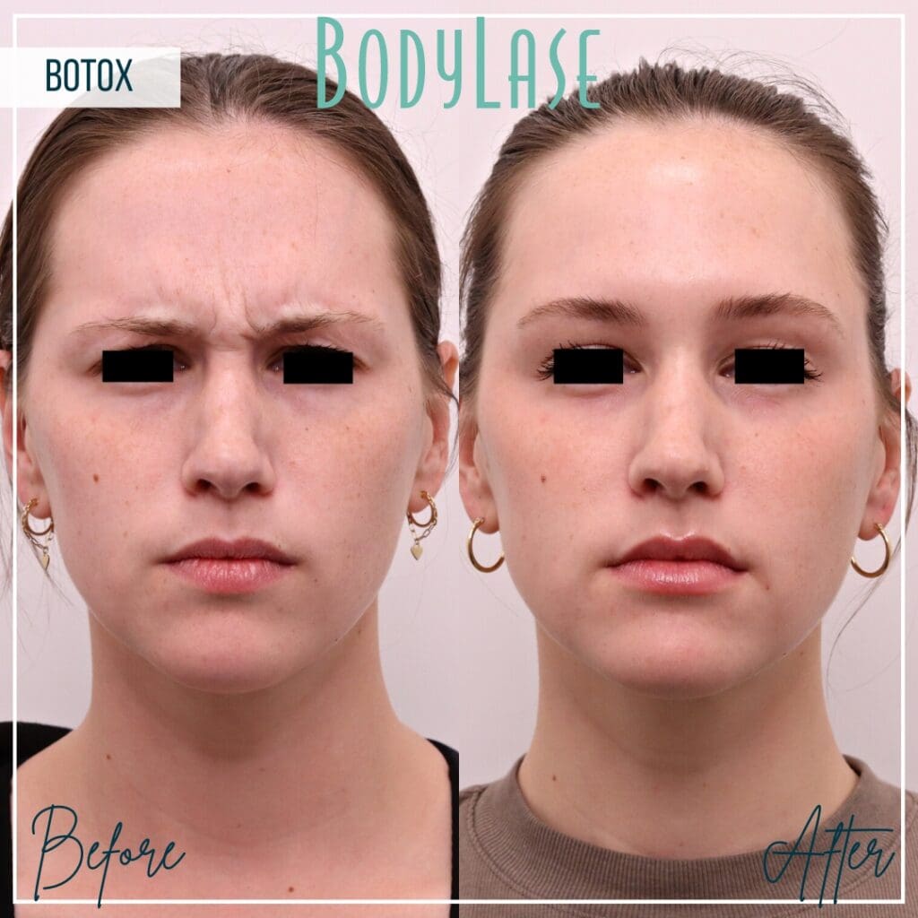 Botox Before and After
