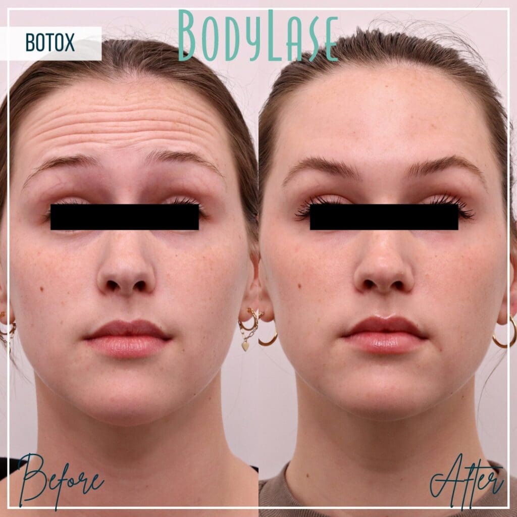 Botox Before and After