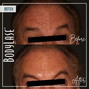 botox Before and After