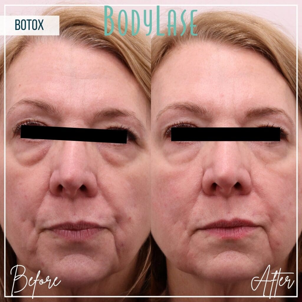 Botox Before and After