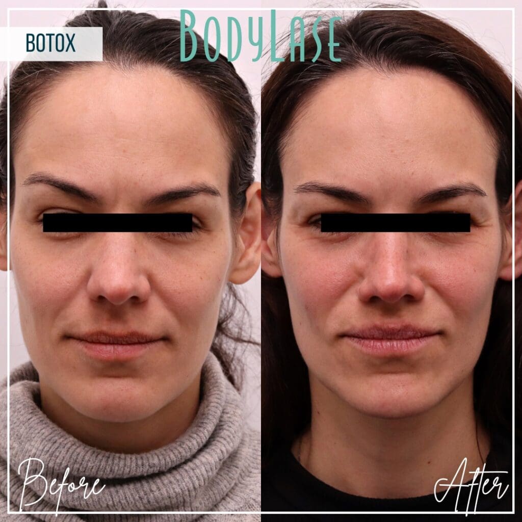 Botox Before and After