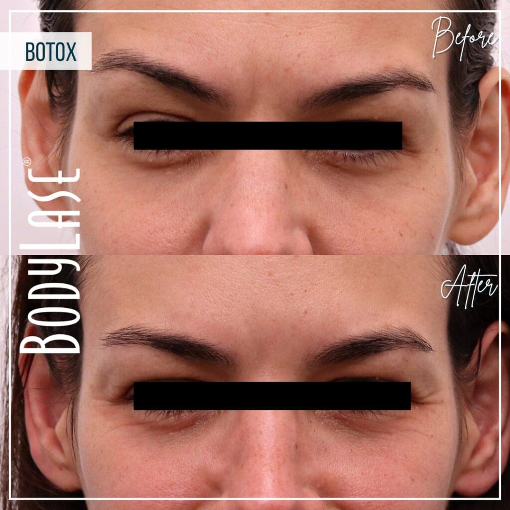 Botox Before and After