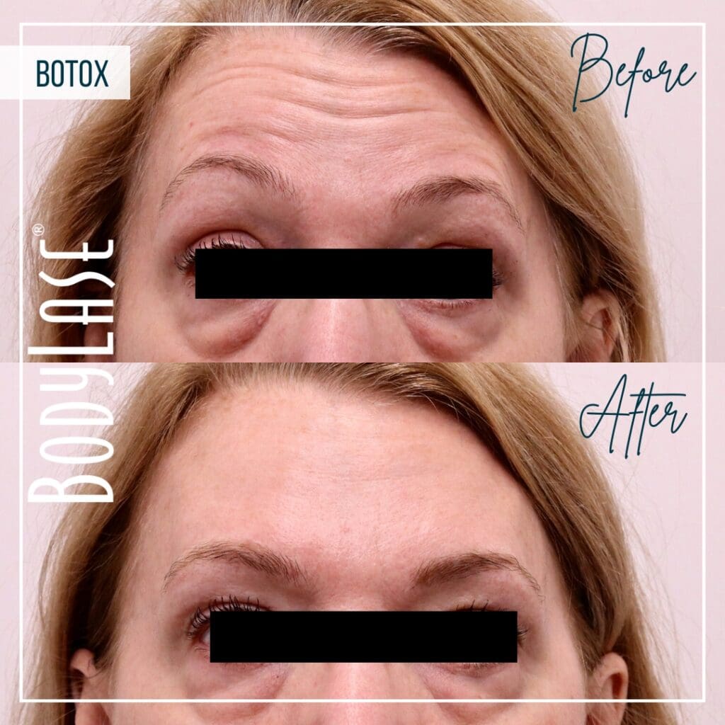 botox Before and After